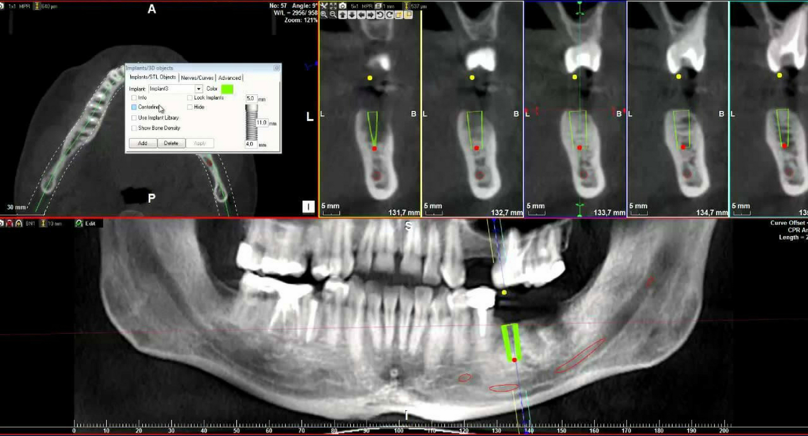 CBCT 촬영