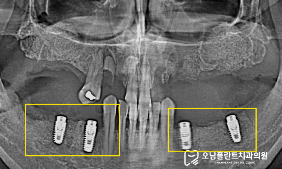 진접역 치과 발치와 CBCT 진단