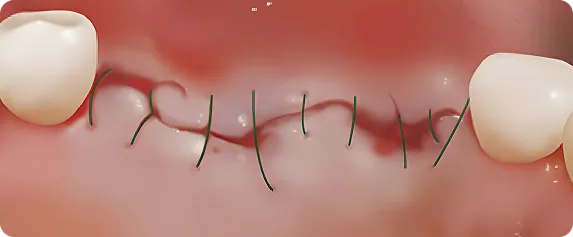 일반 임플란트